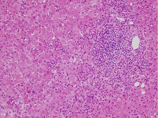 自己免疫性肝炎（AIH）｜難治性の肝・胆道疾患に関する調査研究｜厚生